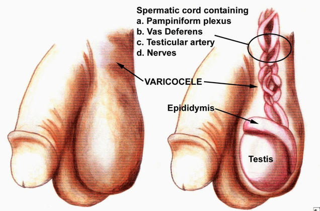 Illustration for article titled Apa Obat Varikokel